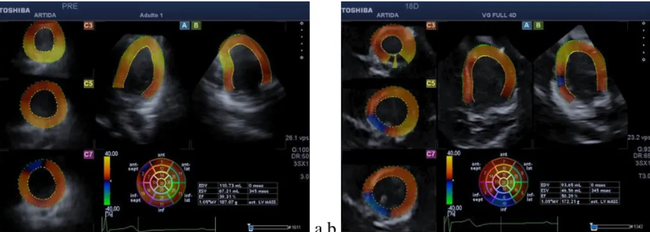 Fig. 2.2. Results obtained in the control (CON, white bars) and countermeasure (RVE, blue bars)  groups relevant to left ventricle diastolic volume (LVDV, left panel) and left ventricle mass (right  panel), at Pre-HDTBR,  at HDT18, and at post