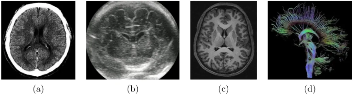 Fig. 2.3 – Diff´ erentes modalit´ es d’imagerie appliqu´ ees au cerveau : le scanner X (image a), l’ul- l’ul-trasonographie (image b), l’IRM anatomique (image c) et le r´ esultat du traitement d’une IRM du tenseur de diffusion (image d).