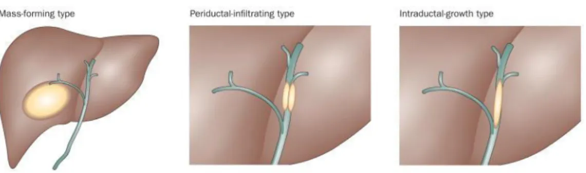 Figure 3: Types de CCI selon l'aspect macroscopique. Blechacz, Nat Rev Gastroenterol Hepatol, 2011 