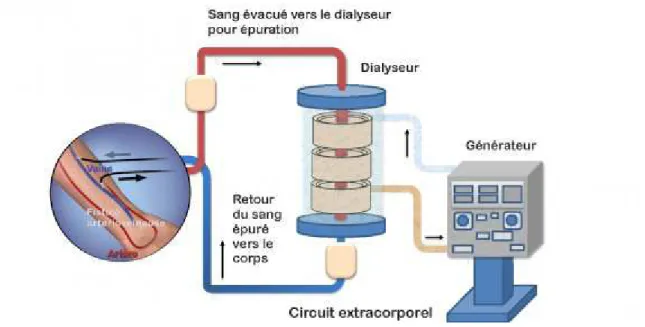 Figure 9: Schéma de l'hémodialyse (Image numérique récupérée sur http://www.aurapc.asso.fr/l-hemodialyse-en- http://www.aurapc.asso.fr/l-hemodialyse-en-unite-de-dialyse) 