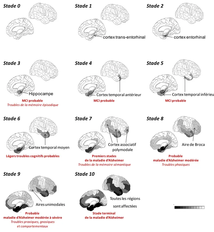 Figure 6 : Evolution des troubles cognitifs dans la MA en fonction de la distribution des DNF  (Adaptée de Delacourte http://www.alzheimer-adna.com/Stades/10stadesFr.html)  