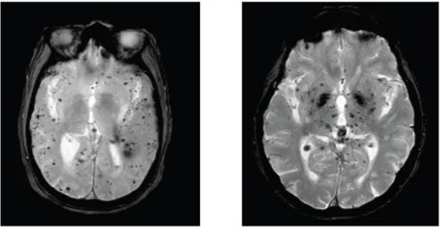 Figure  1:  Illustration  des  microhémorragies  cérébrales  intraparenchymateuses  en  IRM  cérébrales  séquence T2* .