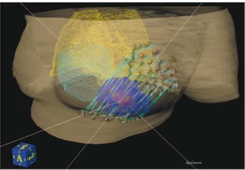 Figure 1.12. La distribution de dose en 3D dans le lit chirurgical en utilisant la curiethérapie  interstitielle « multi-cathéters » 