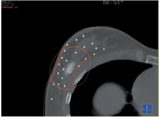 Figure 2.3. Le PTV planifié (en orange) est modifié pour être à 5 mm sous la peau et au  dessus des muscles pectoraux