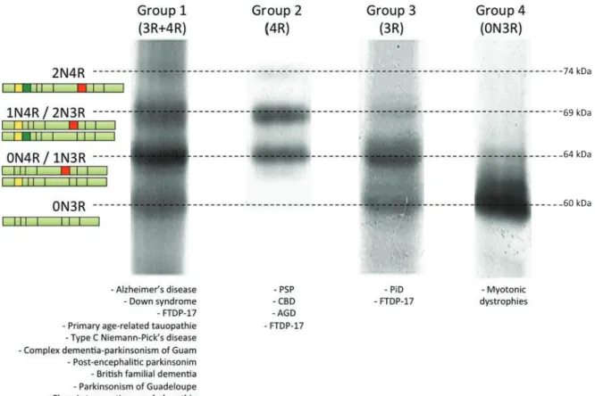 Figure 9 : Code barre des tauopathies.   Western blots représentant le profil électrophorétique  observé avec des agrégats de protéines Tau provenant de patients atteints de différentes  tauopathies