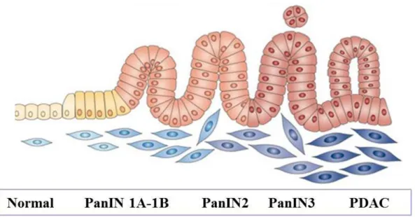 Figure 3 :  Evolution  des  lésions  pré-néoplasiques  intra-épithéliales (Morris,  Wang,  &amp;