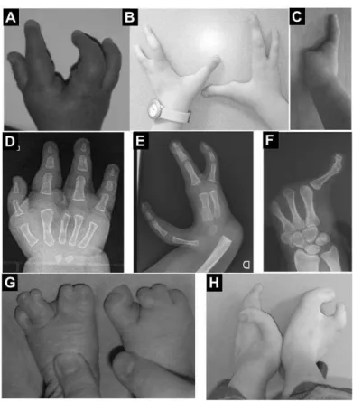 Figure  11 :  Spectre  clinique  des  mains  et  pieds fendus.  