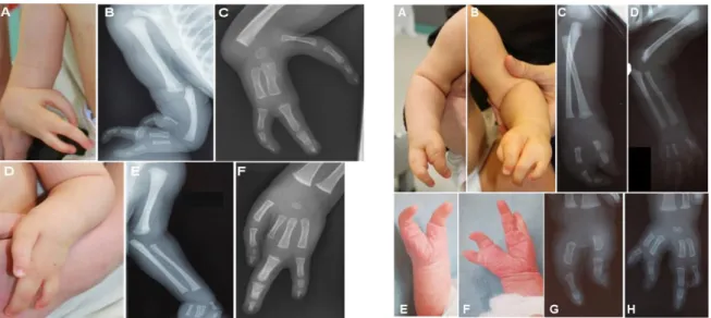 Figure 12 : Malformations des membres supérieurs associées aux duplications 17p13.3. 