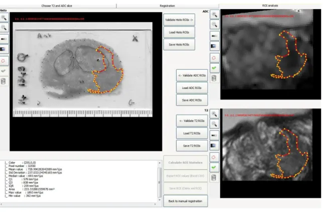 Figure 10.A : Contours de la tumeur en histologie extrapolés à l’IRM. B : Distinction entre VP et FN au sein de la tumeur  contourée en histologie