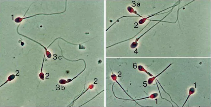 Figure 10 : Analyse des spermatozoïdes sur frottis après coloration de Papanicolaou au  microscope  à  contraste  de  phase