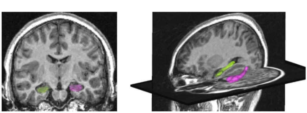 Fig. 4. Left panel: coronal view of the MRI with the meshes of hippocampi segmented by the SACHA software [26], the right hippocampus is in green and the left one in pink