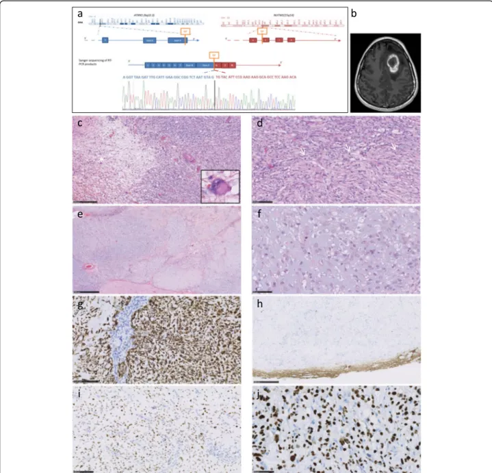 Fig. 1 ATXN1-NUTM1 gene fusion, confirmed by RT-PCR and Sanger sequencing (a). MRI identified a frontal mass