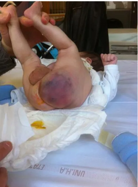 Fig. 1.  Diagnostic: Soft and mobile mass with bruise-like appearance measuring 4 cm in the newborn’s left  buttock, with a deflection of intergluteal sulcus and anal margin to the right