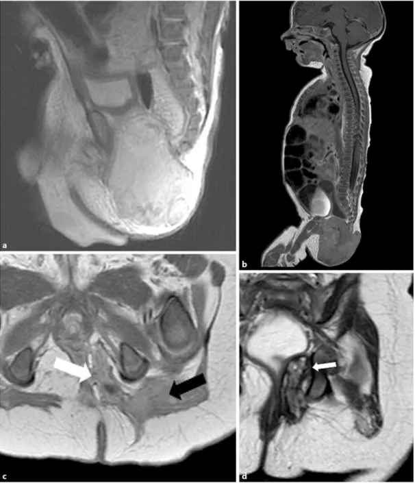 Fig. 2.  Diagnostic and on-therapy MRI. (a) At diagnosis: Sagittal section in T2 sequence