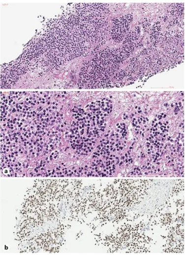 Fig. 3.  (a) Monomorphic round cells (HE ×20 and ×40). (b) Immunohistochemical staining for B-COR