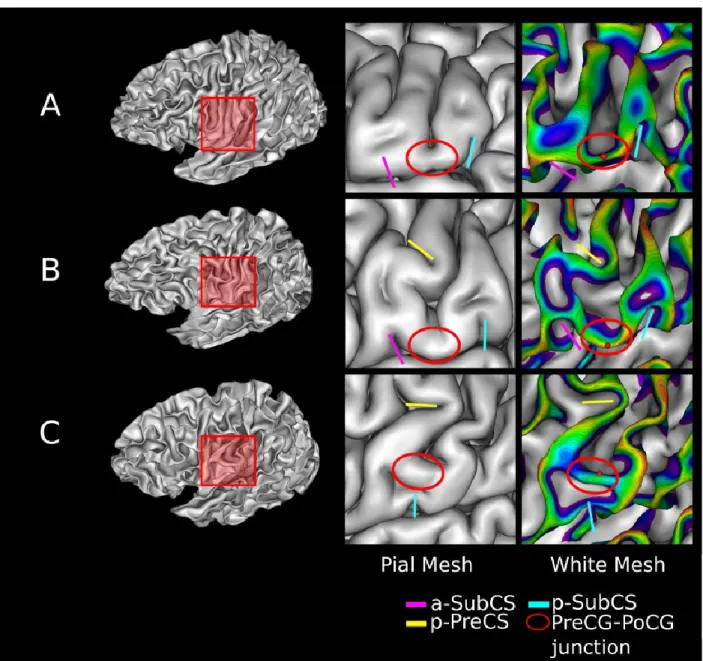 Fig. 6 Positioning of the ventral end of the CS (red sphere) on three GM/WM meshes with different morphological  configurations