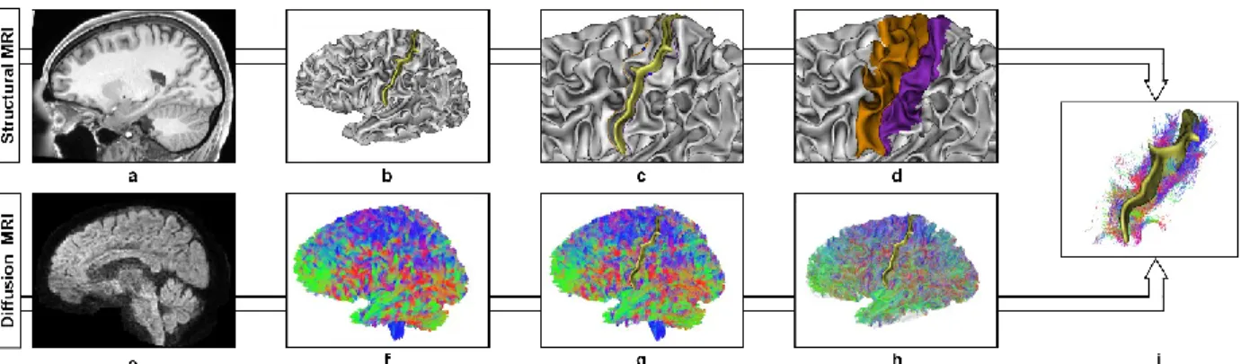 Fig.  1  Central  sulcus  U-shape  streamlines  reconstruction  pipeline  illustrated  on  a  randomly  selected  subject  (id:114621) a  T1w scan pre-processed by the HCP b  Left grey matter/white matter (GM/WM) interface triangular  mesh generated from t