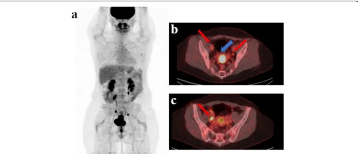 Fig. 2 This is a case (a) of a patient with stage IIB cervical cancer (b blu arrow) studied with TOF PET/CT presenting pelvic pathological lymph nodes (red arrow) located in right (b, c red arrow: 2 lymph nodes), in the left pelvic region (c red arrow: 1 l