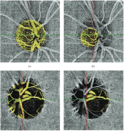 Figure 1: Total (a) and temporal (b) ONH acquisition in a normal patient. Total (c) and temporal (d) ONH acquisition in a glaucoma patient.