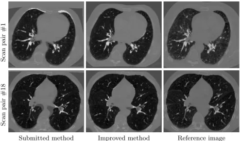 Fig. 4 illustrates the improvement between the two sets of parameters. The new set of parameters visually corrects the lung boundary matching issue