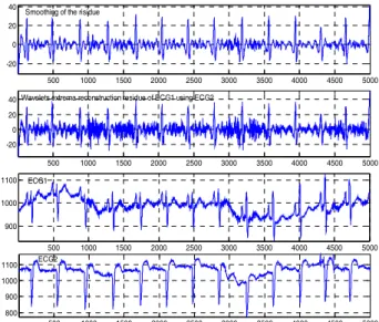 Figure 3. Two remarks can be made: i) baseline  drifts, even different from one channel to the other, do not influence the enhancement of the P waves,  ii) the method is insensitive to QRS morphological changes (here, progressive and disturbing only  one E