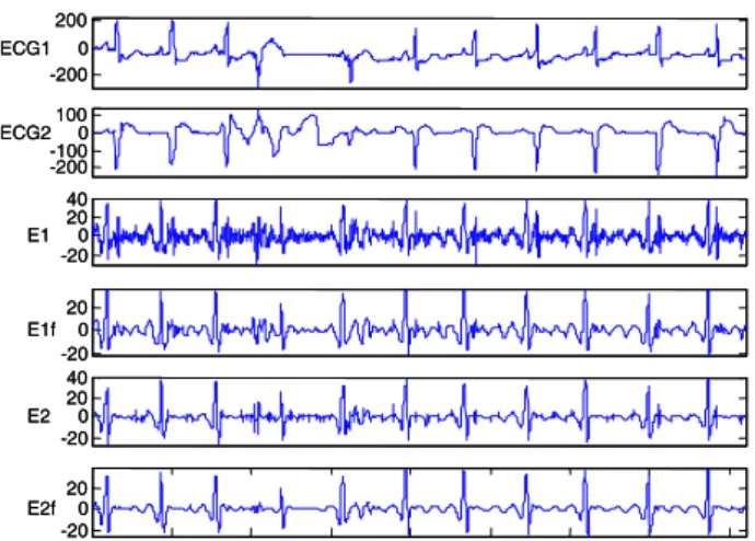 Figure 5 Behavior of the QRS-T cancellation procedure in presence of QRS-T morphology changes  over channels, occurrence of isolated artifact and overlapping of P and T waves (MIT-BIH record 