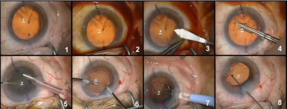 Fig.  2.  Example  of  typical  digital  microscope  images  for  the  eight  phases:  1-preparation,  2- 2-betadine  injection,  3-corneal  incision,  4-capsulorhexis,  5-phacoemulsification,  6-cortical  aspiration of the remanescent lens, 7-implantation