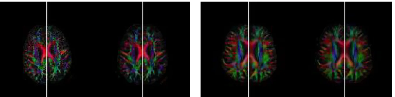 Figure 4. Results on real DTI data. Two patients with Parkinson’s disease (left: original image and right: realigned image)