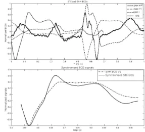 Figure 2. Top: ECG signals acquired in EAM (three derivations) and STE. Bottom: EAM ECG derivation choice (in this example V1) and synchronization by  maxi-mum of correlation.