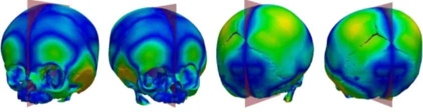 Fig. 1. Evaluation of pointwise asymmetries on a skull with craniosynostosis.