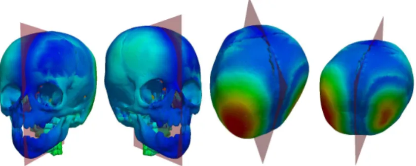 Fig. 2. Evaluation of pointwise asymmetries on a skull with deformational plagiocephaly