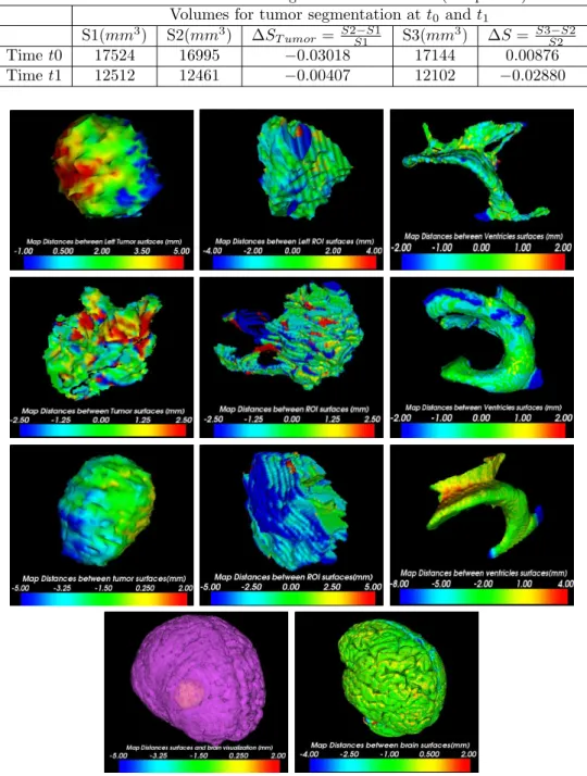 Table 2. Error of manual volume segmentations for tumor (2 nd patient) Volumes for tumor segmentation at t 0 and t 1