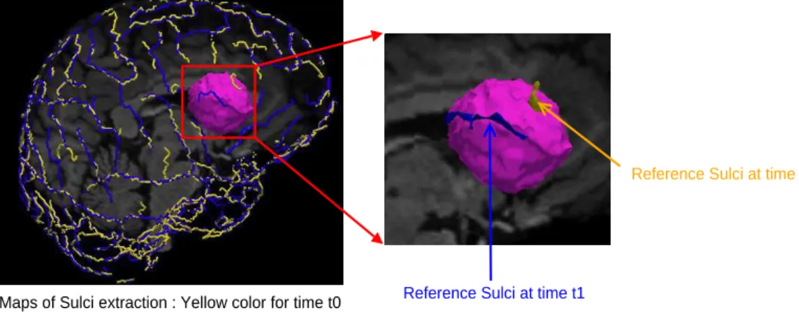 Figure 3. The extraction of sulci based on time t 0 with optimal reference sulci (yellow color) and the extraction based on time t 1 (blue color) with optimal reference sulci to access to the tumor.