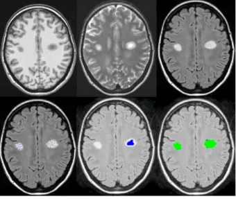 Figure 8. Results on TTF images. Upper row from left to right : T1-w, T2-w and Flair Sequene
