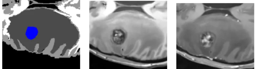 Figure 9. Our segmentation (right), T1 image (middle) and Flair image (left).