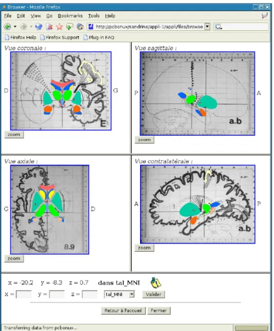 Fig. 1. HTML page generated by the presentation server, for consultation of the Talairach atlas using a web  browser: coronal view (top left),  axial view (bottom left), sagittal view (top right) and contralateral sagittal  view (bottom right).