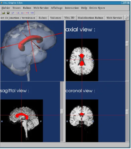Fig. 2. Segmentation and display of MRI images: the top left image shows a SPAM structure retrieved using  the web services (corpus callosum in red).
