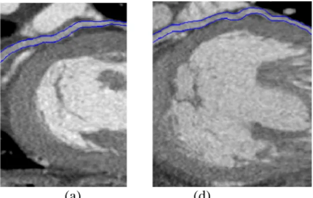 Figure 3. Examples of extracted coronary veins with their  diameter on curvilinear reconstructions: (a) case P1, Great  Cardiac Vein; (b) case P2, Antero-Lateral Vein 