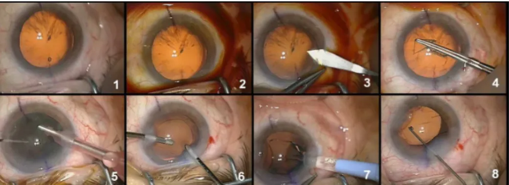 Figure  4.  Typical  images  for  the  eight  surgical  phases:  1-Preparation,  2-Betaisodona  injection,  3-Corneal  incision,  4-Capsulorhexis,  5-Phaco-emulsification,  6-Cortical  aspiration,  7-IOL  implantation,  8-IOL  adjustment and wound sealing
