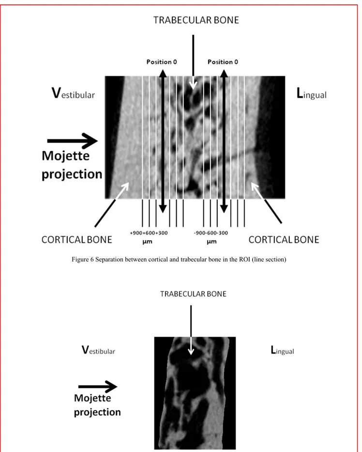 Figure 6 Separation between cortical and trabecular bone in the ROI (line section) 