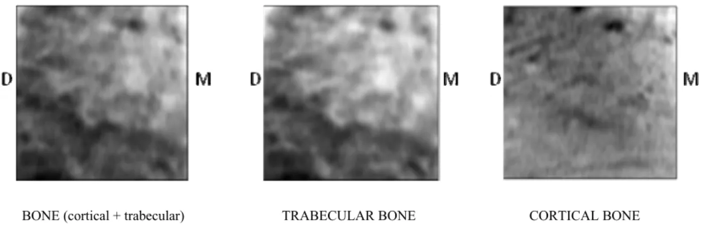 Figure 8: Three examples of calculated simulation image of the ROI : Bone (full projection trabecular and cortical bone), Trabecular  bone alone and Cortical bone alone (line section at position 0)