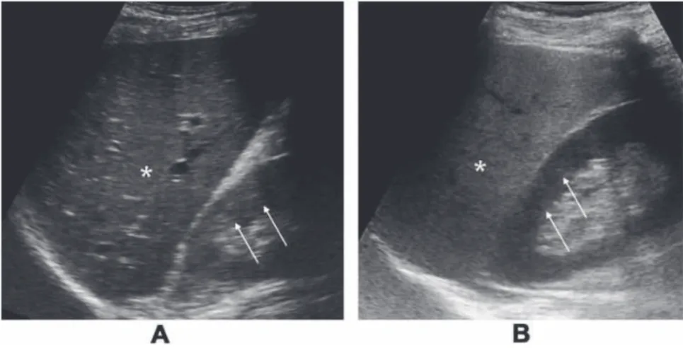 Figure 2.4 – Echographies d’un foie non-stéatotique (A) et stéatotique (B). Chez le patient souﬀrant de stéatose (B), l’échogénicité du foie (étoile blanche) est augmentée par rapport à celle du rein (ﬂèches blanches), alors que dans le cas du foie sain (A