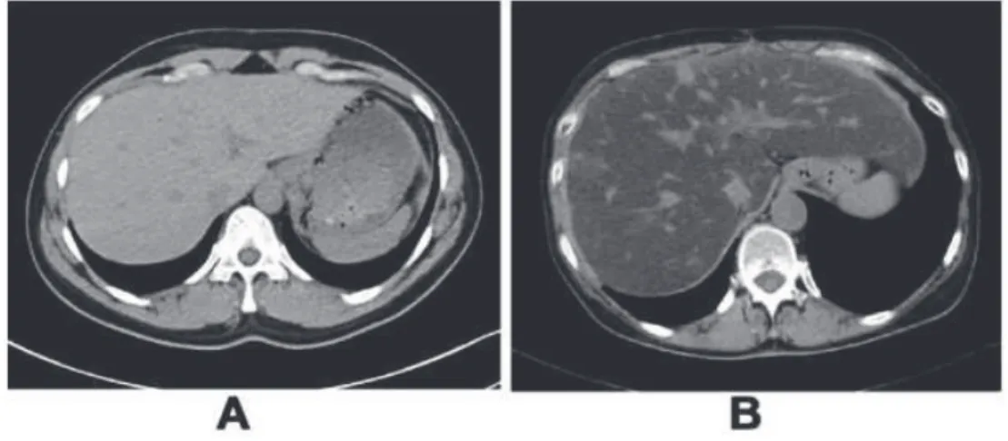 Figure 2.5 – Image tomodensitométrique acquise chez un patient sain (A), le foie apparaît en hypersignal et présente une absorption de 58 UH (rate : 46 UH), et chez un patient atteint de stéatose (B), la valeur d’absorption du foie est de 34 UH (rate : 41 