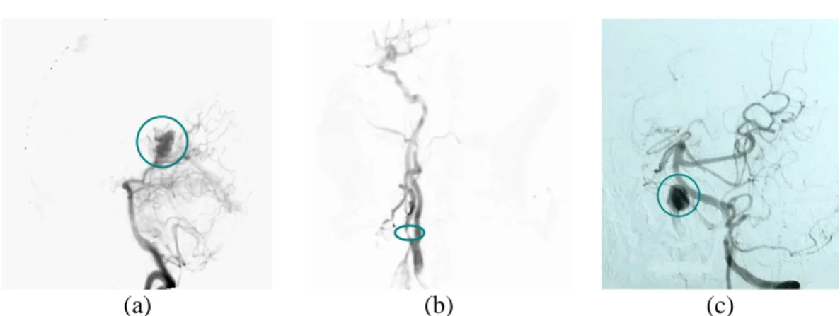 Figure 1. 14 : Pathologies vasculaires, (a) Angiome, (b) Sténose, (c) Anévrisme 