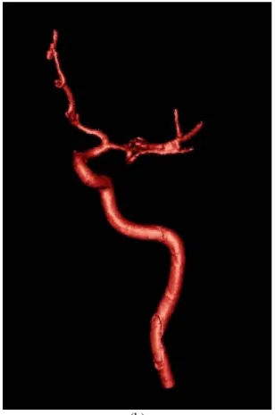 Figure 3. 20 : Visualisation du volume reconstruit pour un morceau de l’arbre vasculaire d’un  patient 