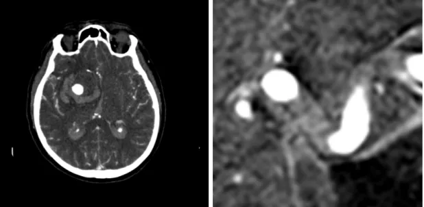 Figure 4: CTA de l’anévrisme cérébral: (1) CTA du cerveau, (2) CTA d’anévrisme.