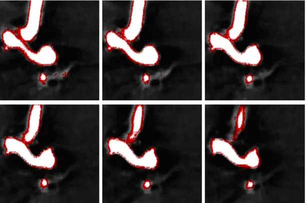 Figure 7: Résultat de segmentation CTA de l’anévrisme cérébral du premier patient, qui prend six coupes d’anévrisme cérébral comme exemples de segmentation 2D