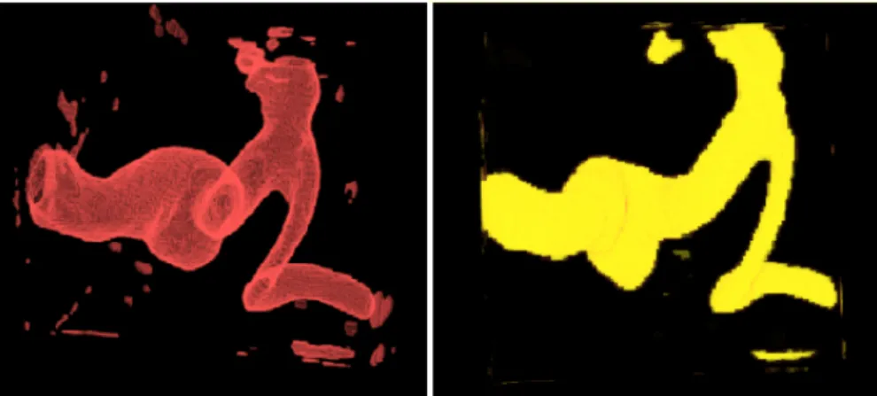 Figure 12: Segmentation par la méthode proposée: la gauche: vaisseau parent (rouge), la droite: phase sanguine (jaune).