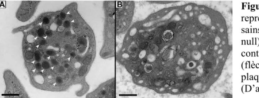 Figure  10 :  Microscopie  électronique  représentant  des  plaquettes  d’un  donneur  sains  et  d’un  patient  ARC  (VPS16B  null)
