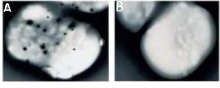 Figure  13 :  Microscopie  électronique  montrant des plaquettes avec des granules  denses normaux (A) et des plaquettes d’un  patient  HPS  montrant  l’absence  de  granules denses (B)